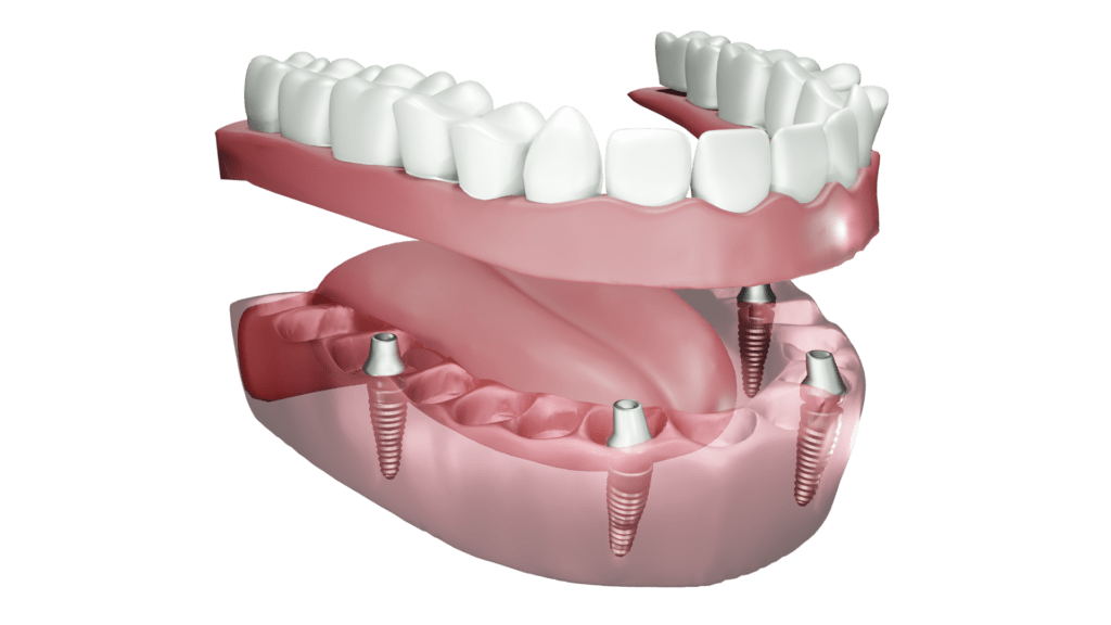 Импланти all-on-four